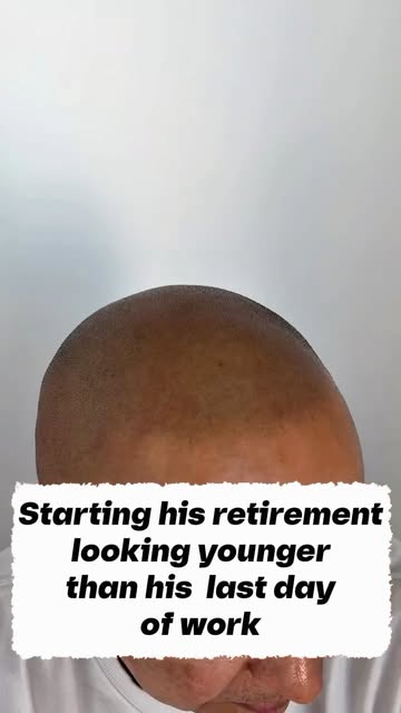 He clocked out of work for good and clocked into his glow-up. 🔥

A fresh, natural-looking hairline 