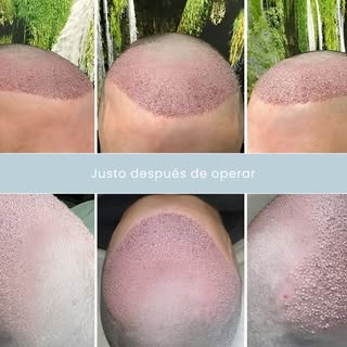 ✨ Así de limpia y precisa se ve una intervención justo al terminar en quirófano.

🔬 La clave de un 
