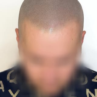 Scalp micro  pigmentation by tattooist Afanasev Andrey 😉. #трихопигментация
#scalpmicropigmentation