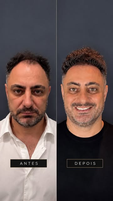 Quando a queda de cabelo começa a afetar a sua autoestima, você já não olha para o cabelo da mesma f