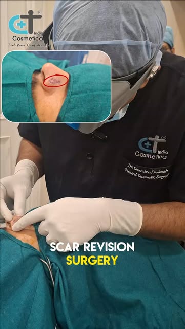 ✨ Struggling with visible scars?

Scar revision treatment can help improve the appearance of acne sc