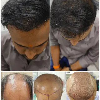 ✨ Avinash Sawant 08-Months Hair Transplant Journey! ✨

It’s been 08 months since Avinash Sawant unde