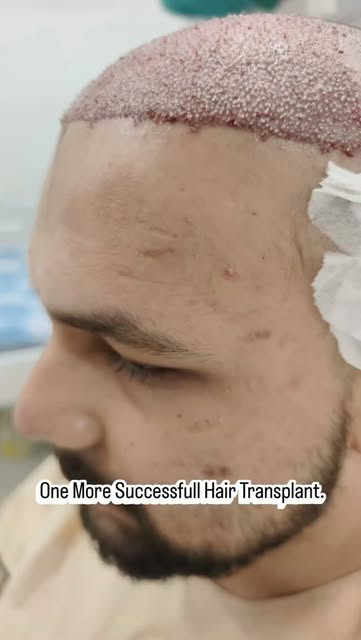 One more Successfull Hair Transplant.