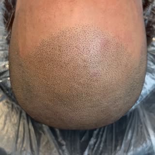 THE CHOICE IS YOURS 👇🏽

SCALP MICROPIGMENTATION 
@flawless.smp ARTIST: DONNA FATHI
VANCOUVER BC CA