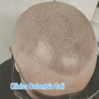 #micropigmentacion #alopecia #imagen #calvicie #cabello