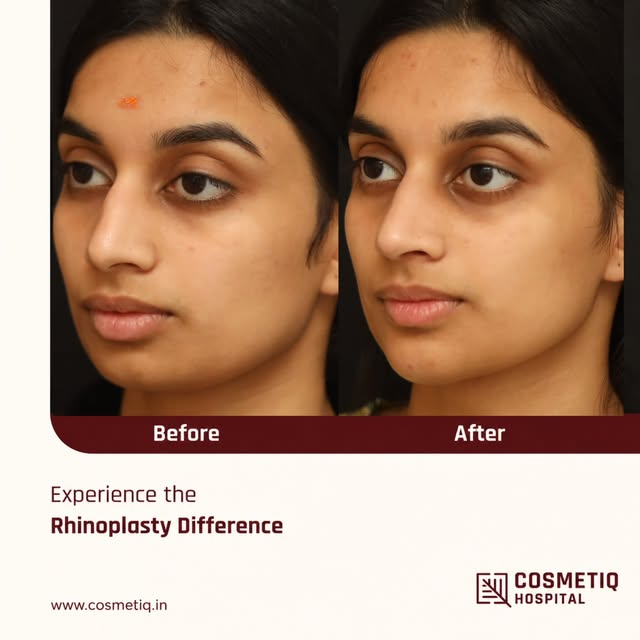 Subtle changes. Beautiful balance 👩🏻‍💼

Refining the nose and chin can enhance facial harmony and