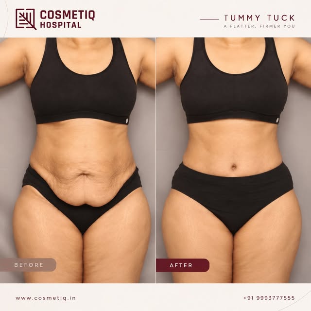 A flatter, firmer abdominal contour — with a natural, proportionate result.

This tummy tuck transfo