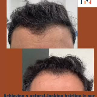 #hairtransplant #rnaplusclinics #prphairrestoration #hairtransformation #kondapur