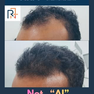 Not “AI”. Not a “Hair Patch”.

Just REAL Hair Growth.

A genuine transformation achieved in just 5 m