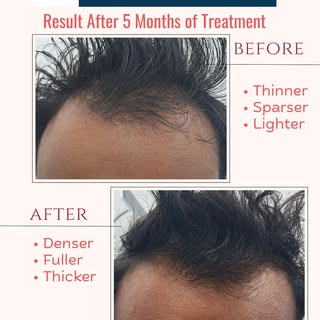 From thinning to thriving in just 5 months ✨

Consistency + the right treatment plan = visible trans