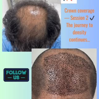 Second session done — crown area now strategically covered to restore density where it matters most.