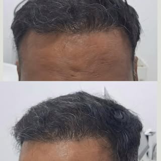 Grade VI Baldness ➜ Full Coverage. 🔥

The best transformation isn’t just about hair—it’s about gett