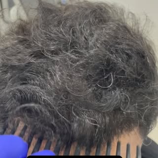✨ 8 Months After Hair Transplant — The Transformation Speaks for Itself! ✨

A natural-looking hairli