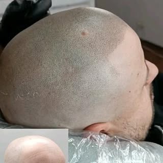 Una solución definitiva a la alopecia o falta de densidad.
Asesorate con nosotros sobre ésta técnica
