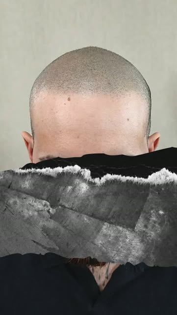 Micropigmentación capilar para recuperar visualmente zonas afectadas por la alopecia.

En este caso,