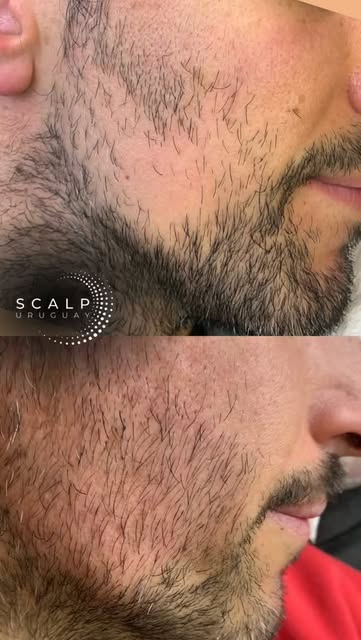 ⚜️ Nuevo servicio: Micropigmentación de Barba ⚜️

✨Exclusivo de Scalp Uruguay✨

Una técnica diseñada