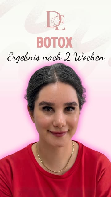 Botox❤️

#berlinbotox #botoxberlin #berlinlips #berlinlippen #berlinlippenmithyalouron