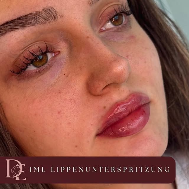 1ml Lippenunterspritzung💋

#berlinlippen #berlinlips #berlinlippenmithyalouron #berlinbotox #berlin