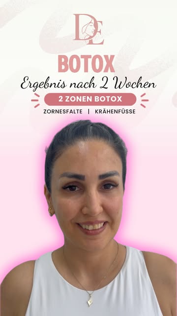 Botox entspannt gezielt die behandelten Muskeln und kann dadurch mimische Falten glätten. Die Wirkun