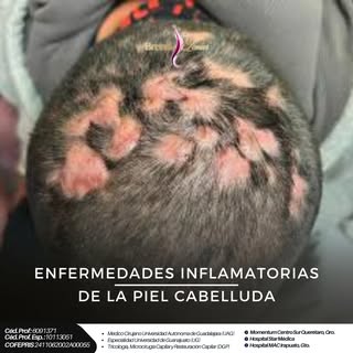 🩺✨ ¿Tienes “caspa” que no mejora… o estás viendo zonas enrojecidas, costras, dolor o caída?
La infl