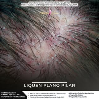 ✨ No toda caída del cabello es igual
Cuando la pérdida capilar viene acompañada de ardor, dolor o in