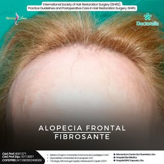 💇‍♀️ ¿Has notado que tu línea frontal cambia, hay ardor, tirantez o pérdida de cejas?
La alopecia f