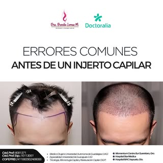 🚨 El error más costoso en un injerto capilar puede ocurrir incluso antes de la cirugía.

Antes de t