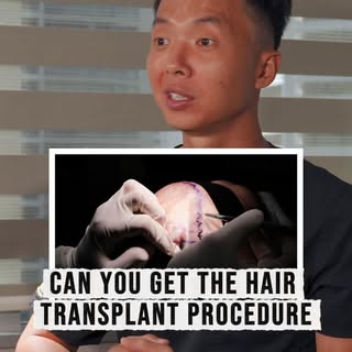 Many patients ask if they can go for multiple hair transplants. The short answer is yes, but it requ