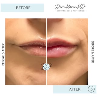 POV: You found your new favorite lip injector in Madera. 👄✨

⬅️ SWIPE for the full side-by-side pro