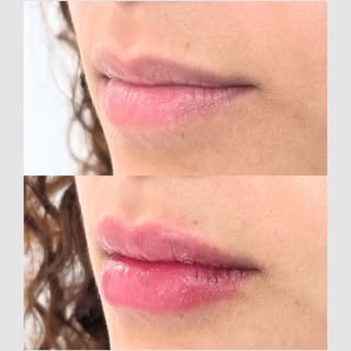 A touch of volume! Lip filler, when done right, looks like you natural and refreshed!

#dermatology#
