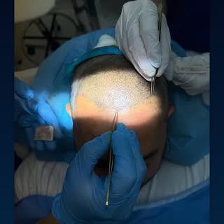 #trapiantodicapelli #trapintocapelli #fue #hairtransplant
