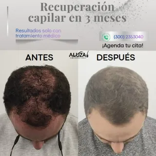 Hace 3 meses, Juan Felipe estaba perdiendo cabello todos los días 😔
Hoy, no puede dejar de tocársel