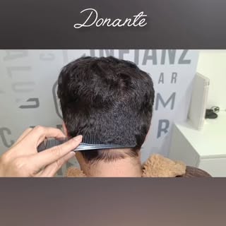 14 meses después de extracción de 2500UF, así luce zona donante 💫

Recuperar tu cabello es posible.