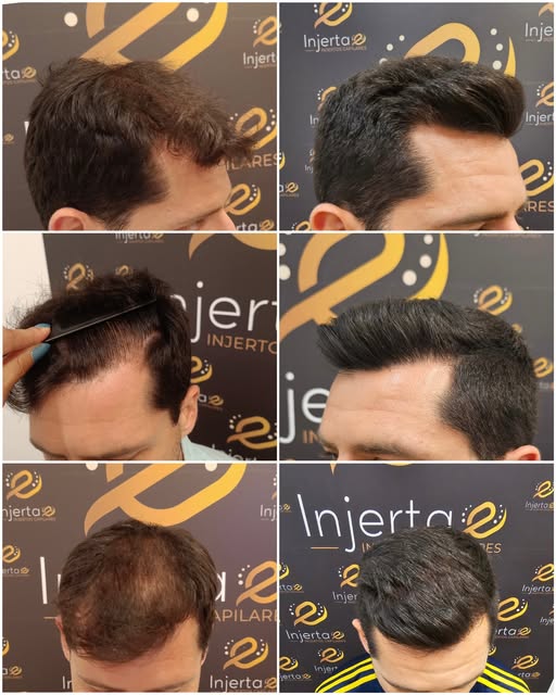 12 meses , reconstrucción de la primera línea frontal y redensificacion 

Realizado :
- Zafriro 1,2
