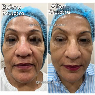 I JUST LOVE SCULPTRA

Nowadays, in my practice, I use more biostimulators such as PLLA (Sculptra) an