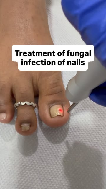 Fungal infection of the nails is called onychomychosis
It can be treated with laser treatment called