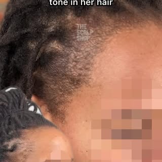 Our friend Fiona suffered from hair loss since she was a child - from accidentally ripping out a kno