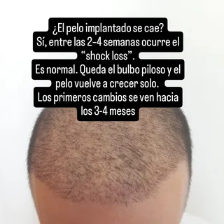 ¿El pelo implantado se cae?
Sí, entre las 2–4 semanas ocurre el “shock loss”.
Es normal. Queda el bu