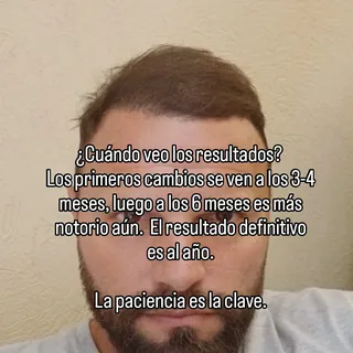 ¿Cuándo veo los resultados? 
Los primeros cambios se ven a los 3-4 meses, luego a los 6 meses es más