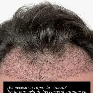 ¿Es necesario rapar la cabeza?
En la mayoría de los casos sí, aunque en caso de entradas y primera l