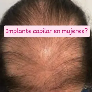 La alopecía androgenética afecta tanto a hombres como a mujeres, y en cada caso se presenta de disti