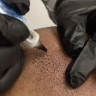 Check our clients perfectly replicated hair follicles and exact density to match seamlessly with HIS