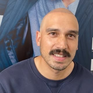 Our client Will was originally treated by us over 10 years ago. Due to the nature of his Alopecia Ar
