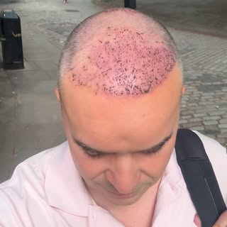 Last Friday I was in the chair, not behind it — my second hair transplant, to address the occipital 