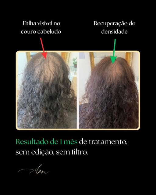 1 mês de tratamento. Resultado real, sem filtro!

Quando existe avaliação, protocolo e acompanhament