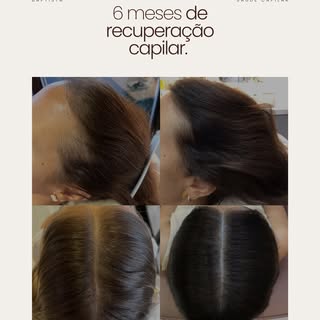 Calvície feminina tem tratamento?  Tem! 
É possível melhorar o volume capilar com o tratamento? 
Sim