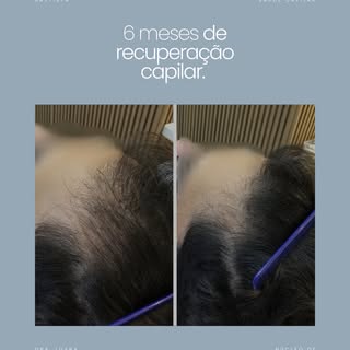 Entre uma foto e outra, 6 meses de tratamento.

Mas tem uma parte dessa transformação que a câmera n