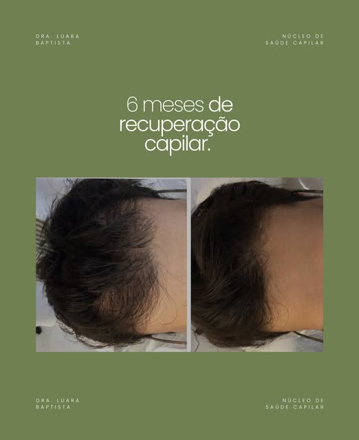 Entrada mais aberta, fio mais fino, coroa aparecendo.
Se você já reparou em algum desses sinais no e