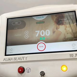 Q switched laser works wonders for #freckles #pigmentation #melasma #birthmarks #tattoo 
 .
Book a s
