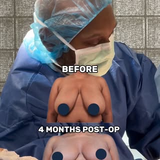 Four months post-op, and the difference is truly life-changing! 👏🍒

This beautiful breast reductio